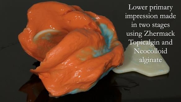 Complete denture Class II div 2 deep overbite Newsletter 39