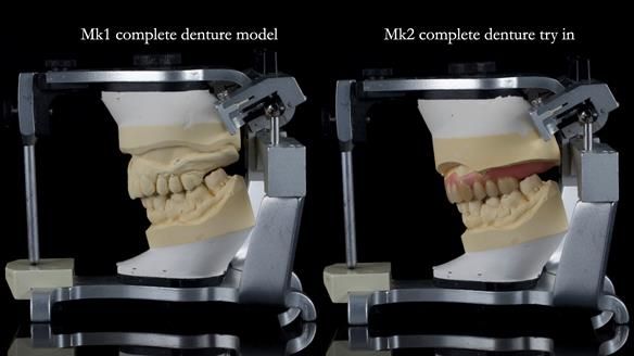 Newsletter 77: Jeremy’s case – immediate complete upper denture
