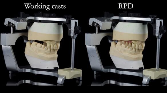 Newsletter 56 showing the making and fitting of a bilateral free end saddle upper removable partial denture (RPD) for patient with pemphigus