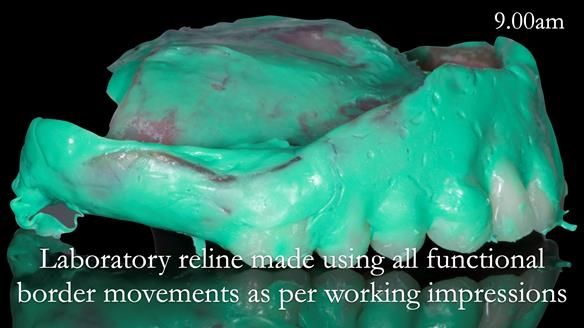 Newsletter 52 Managing Jo’s failing dentition with extractions and Mk 1/Mk 2 complete upper dentures and lower partial dentures FULL PROTOCOL