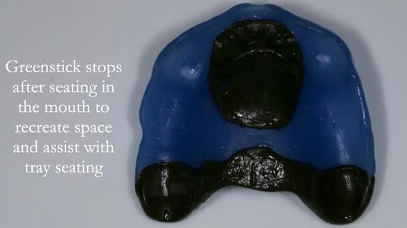 Newsletter 57 showcases the making and fitting process of implant-supported complete dentures for Alisdair