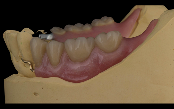 Figure 108 Mk 2 mandibular metal based denture with Schottlander Enigmalife teeth. Gum colouring - Vertex with 0.9 mm wrought gold clasps on LR4 and LL3