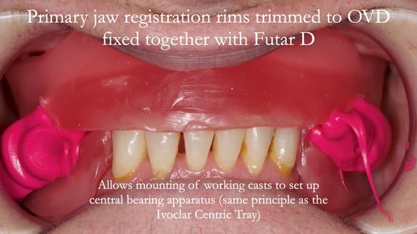 Newsletter 52 Managing Jo’s failing dentition with extractions and Mk 1/Mk 2 complete upper dentures and lower partial dentures FULL PROTOCOL