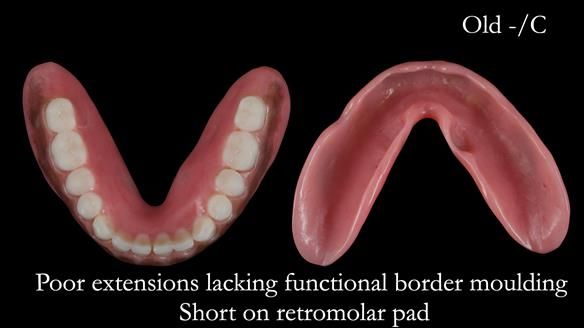 Newsletter 53 showing the making and fitting of ultra life-like dentures for Valena