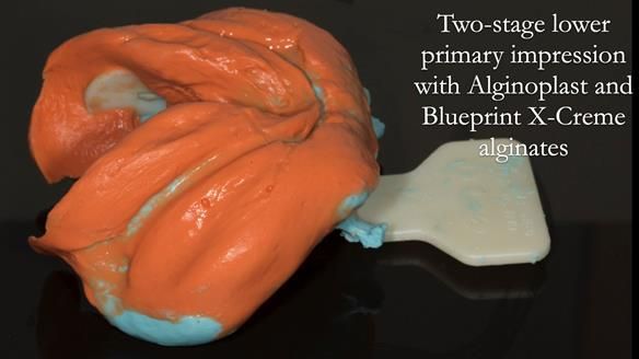 Newsletter 75: Marion’s case - Step-by-step complete denture workflow