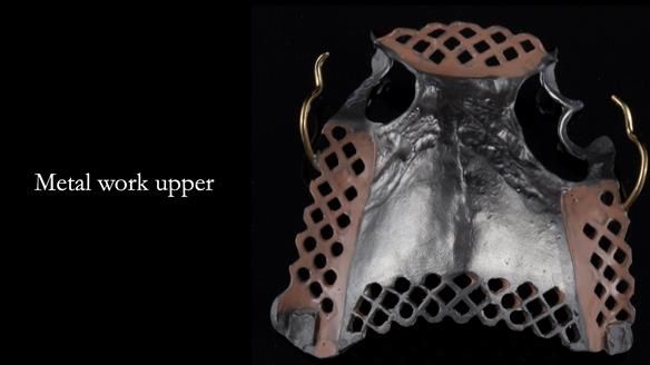 Finlay's Newsletter 59 Ultra hard partial dentures made for Gill