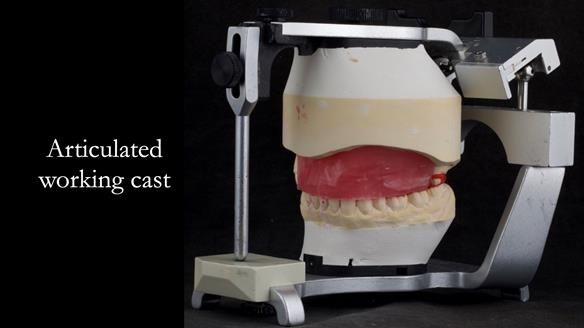 Upper metal base partial denture/occlusal stabilisation splint/obturator - full protocol
