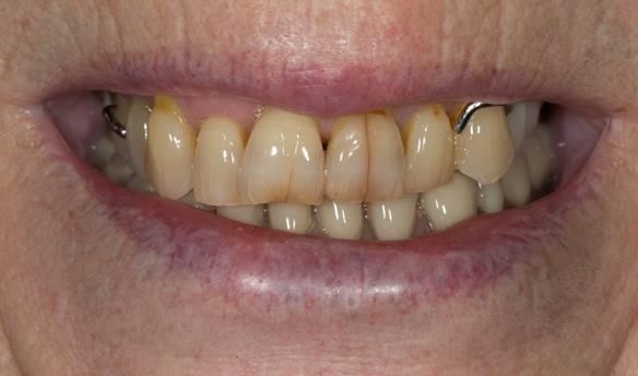 Figure 2 Pre - treatment. High smile line showing metal clasp. Upper partial denture and lower complete denture.