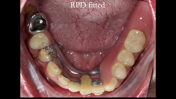 Newsletter 55 Provision of metal based partial dentures for Zephyrine with a repaired cleft lip and palate