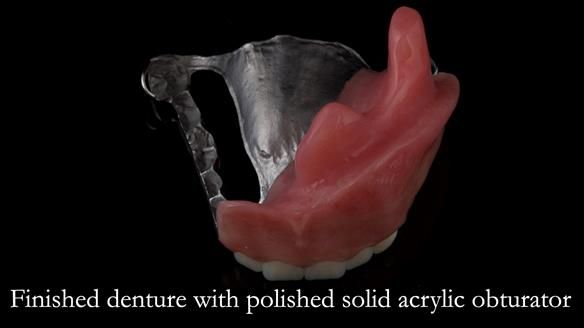 Upper metal base partial denture/occlusal stabilisation splint/obturator - full protocol