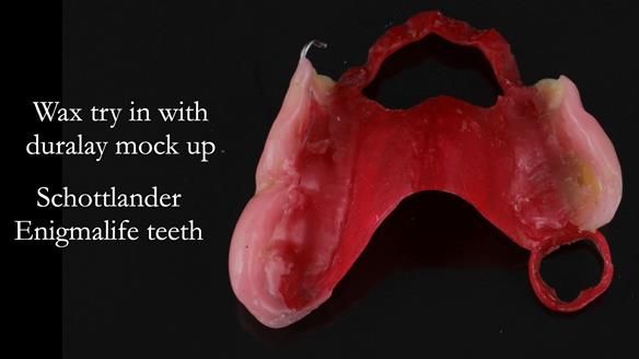 Finlay's Newsletter 60 Sylvia's upper Kennedy Class 2 Mod 1 metal based upper RPD