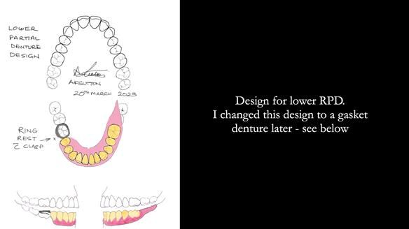 Newsletter 82 Mary - A complete upper and a one-tooth gasket denture