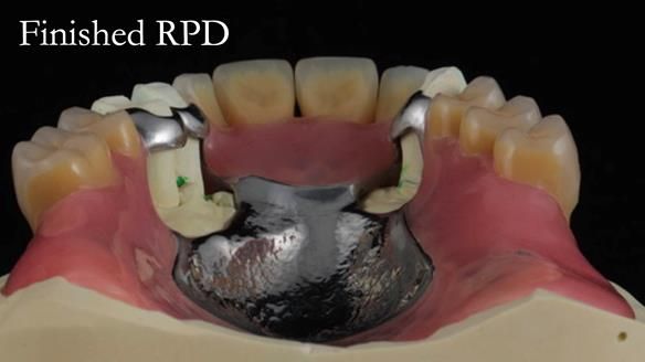 Finlay's Newsletter 59 Ultra hard partial dentures made for Gill