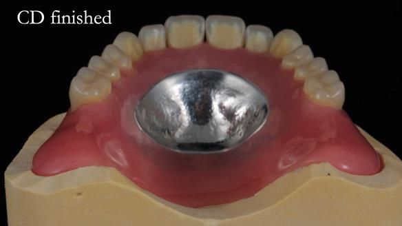 Finlay's Newsletter 62 provision of extractions and metal based complete dentures for Rafique