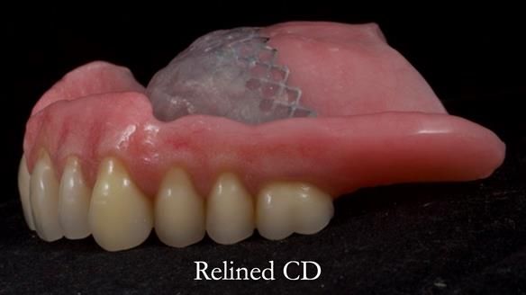 Finlay's Newsletter 62 provision of extractions and metal based complete dentures for Rafique