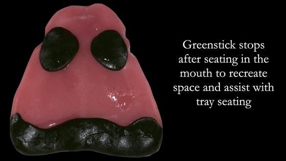 Replacing Madeline’s Complete denture FULL PROTOCOL