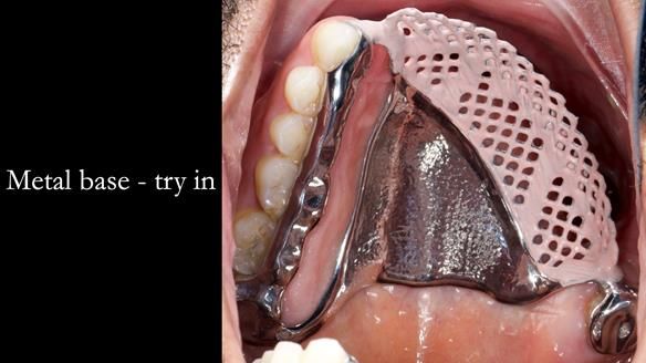 Upper metal base partial denture/occlusal stabilisation splint/obturator - full protocol