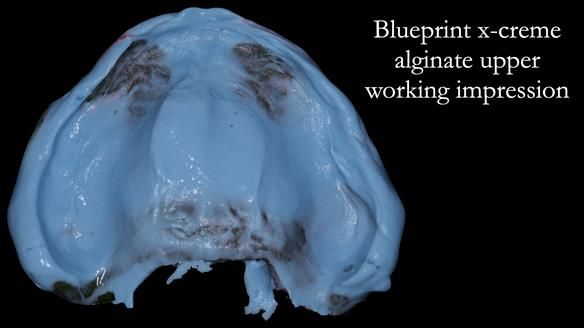 Newsletter 52 Managing Jo’s failing dentition with extractions and Mk 1/Mk 2 complete upper dentures and lower partial dentures FULL PROTOCOL