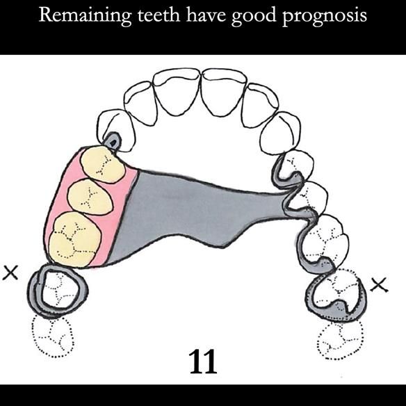 Universal Scandinavian partial denture designs