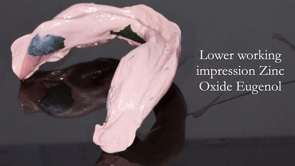 Complete denture Class II div 2 deep overbite Newsletter 39