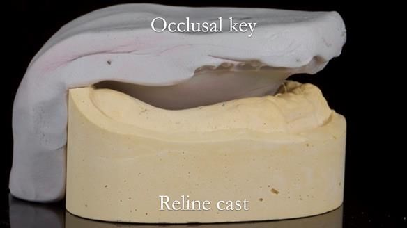 Finlay's Newsletter 62 provision of extractions and metal based complete dentures for Rafique