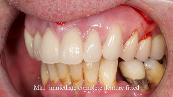 Newsletter 77: Jeremy’s case – immediate complete upper denture
