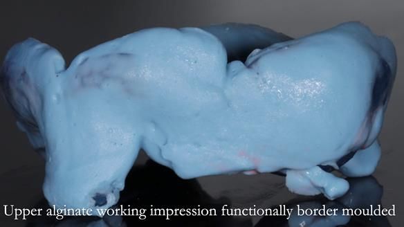 Finlay's Newsletter 58 Gasket upper partial denture for Zoe