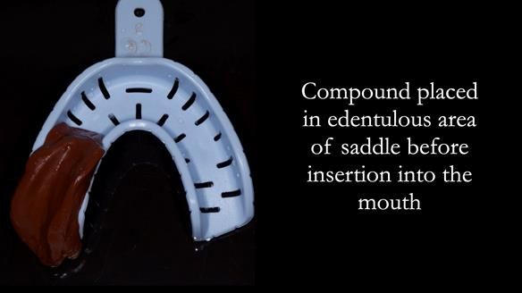 Newsletter 54 case presentation upper complete denture and lower Scandinavian designed hygienic partial denture for David