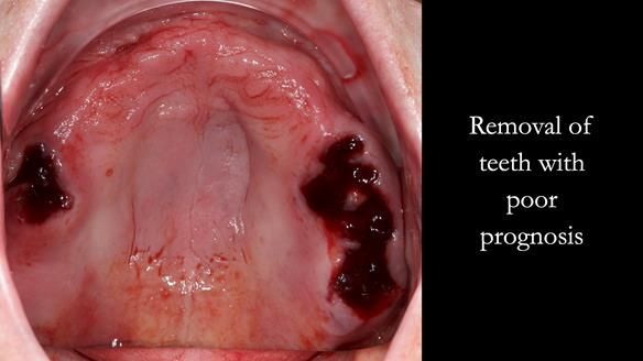 Newsletter 52 Managing Jo’s failing dentition with extractions and Mk 1/Mk 2 complete upper dentures and lower partial dentures FULL PROTOCOL