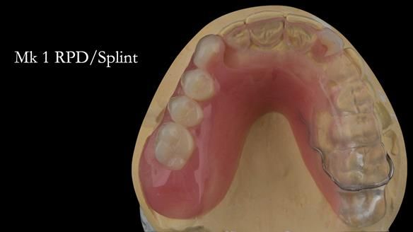 Newsletter 51 Managing Anne’s failing dentition with distal extension base RPD/Splint FULL PROTOCOL