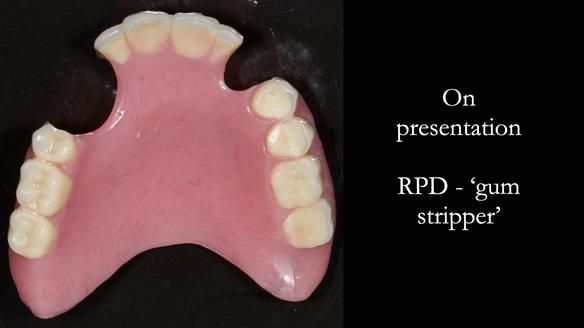 Finlay's Newsletter 59 Ultra hard partial dentures made for Gill