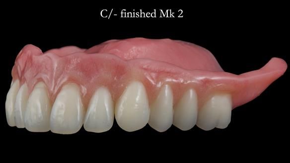 Newsletter 52 Managing Jo’s failing dentition with extractions and Mk 1/Mk 2 complete upper dentures and lower partial dentures FULL PROTOCOL