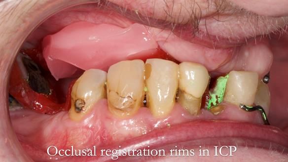 Newsletter 55 Provision of metal based partial dentures for Zephyrine with a repaired cleft lip and palate