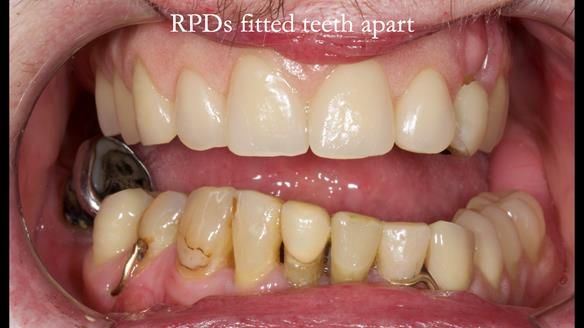 Newsletter 55 Provision of metal based partial dentures for Zephyrine with a repaired cleft lip and palate