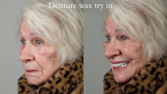 Newsletter 65 Marisa Provision of Complete Dentures on badly placed implants