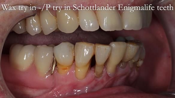 Newsletter 54 case presentation upper complete denture and lower Scandinavian designed hygienic partial denture for David