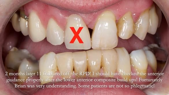 Read Newsletter 67 - Brian's COMBAT DENTURE Case Study