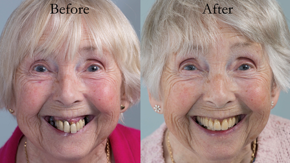 Figure 103 Before treatment and after treatment with definitive Mk 2 complete denture