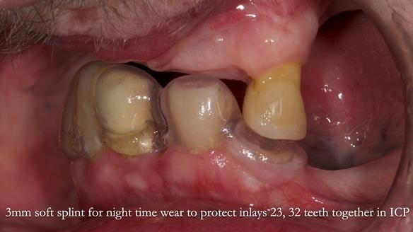 Newsletter 55 Provision of metal based partial dentures for Zephyrine with a repaired cleft lip and palate