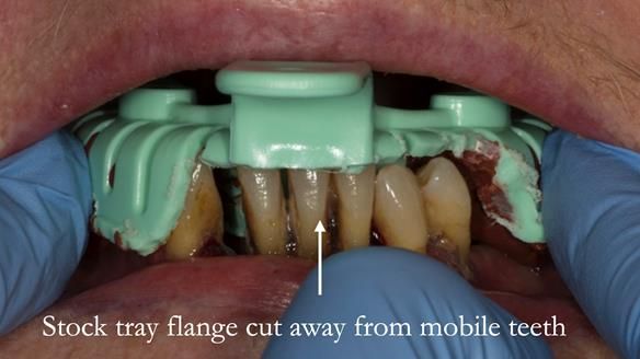 Finlay's Case Study Newsletter 40 - Immediate Mk 1 RPD to Definitive Mk 2 RPD - full protocol