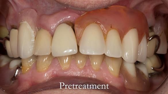 Eileen's transformation with upper and lower RPDs of Scandinavian hygienic design FULL PROTOCOL