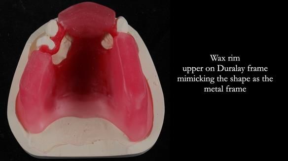 Finlay's Newsletter 59 Ultra hard partial dentures made for Gill