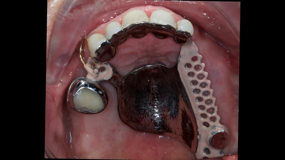 Newsletter 89 – Simon: A Challenging Kennedy Class II Division 1 Upper CoCr Partial Denture with a High Smile Line