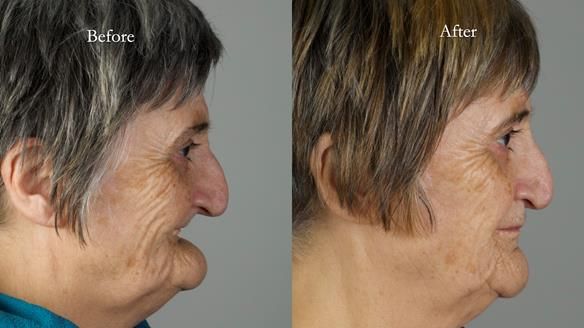 Newsletter 83: Sheila’s Complete Denture Success