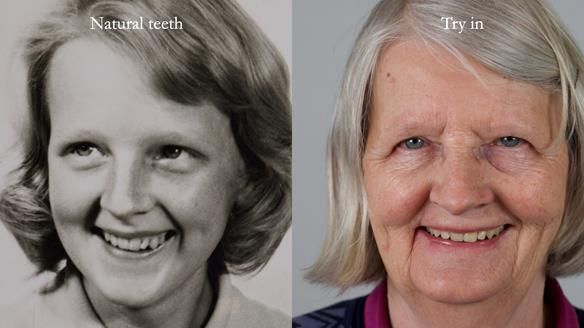 Newsletter 82 Mary - A complete upper and a one-tooth gasket denture
