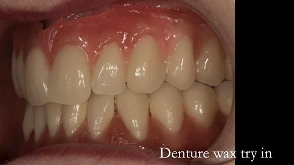 Newsletter 75: Marion’s case - Step-by-step complete denture workflow