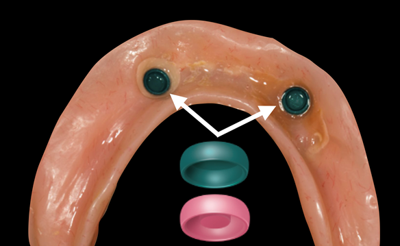 Figure 11 The attachment inserts were then changed from pink to green to allow the denture to seat
