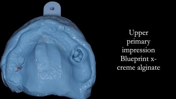 Newsletter 52 Managing Jo’s failing dentition with extractions and Mk 1/Mk 2 complete upper dentures and lower partial dentures FULL PROTOCOL