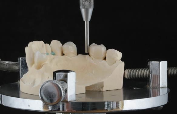 Figure 50 Porcelain fused to zirconia crown crowns incorporating parallel guiding surfaces, ledges and rest seats for the metal based partial dentures.
