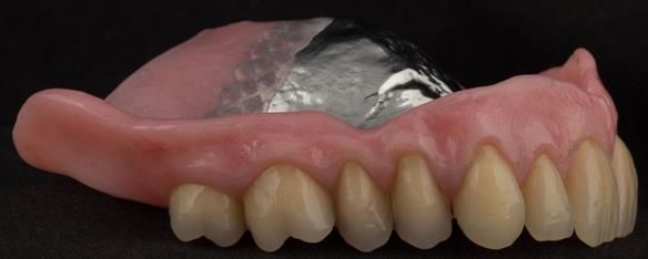 Figure 106 Mk 2 maxillary metal based denture with subtlety characterised Schottlander Enigmalife teeth. Gum colouring - Vertex